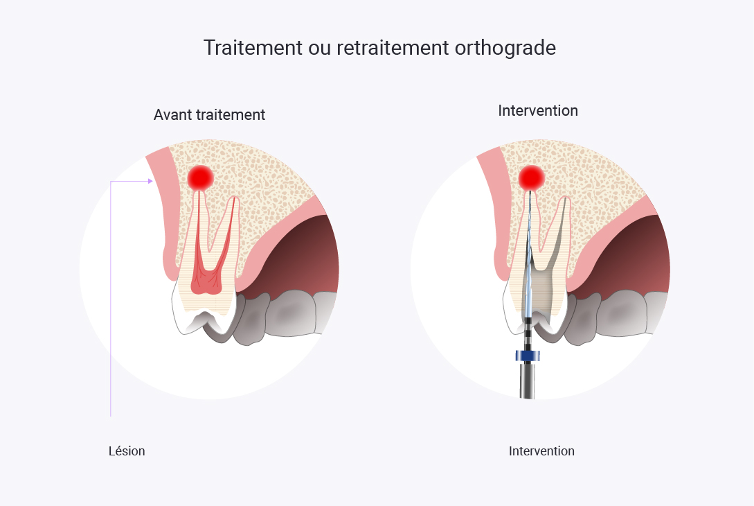 schemas-eve-laurent-03 schéma-traitement endodontique