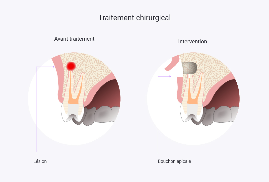 schemas-eve-laurent-04 Chirurgie endodontique