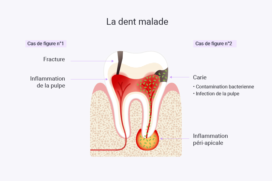 schemas-eve-laurent_2 schéma d'une dent malade